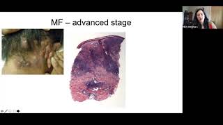 Pathology Grand Rounds  Cutaneous TCell Lymphoma  Dr Michi Shinohara [upl. by Rondon]