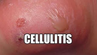 Cellulitis What is it Treatments Causes and Symptoms [upl. by Yniattirb841]