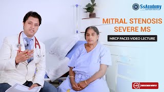 MRCP PACES Clinical Case  Cardiology  Severe Mitral Stenosis MS [upl. by Wilkins107]