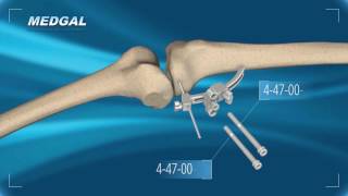 Tibial Osteotomy TECHNIQUE [upl. by Dolly]