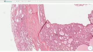 Follicular Adenoma  Thyroid Gland Histopathology [upl. by Lener]