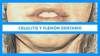 Concepto de celulitis y flemón dentario [upl. by Sahpec]