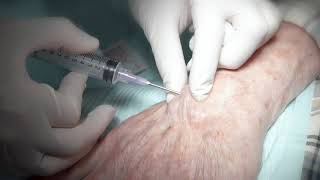 Aspiration of ganglion cyst [upl. by Gillie]