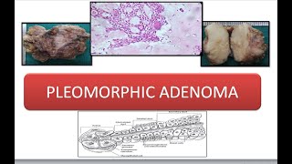 Pleomorphic Adenoma [upl. by Guntar]