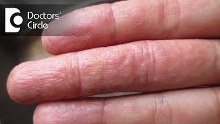 What is atopic dermatitis  Dr Rashmi Ravindra [upl. by Siugram]