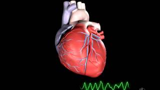 What is Ventricular Fibrillation [upl. by Tomasina]