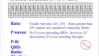 ECG Ventricular Tachycardia VT [upl. by Shirberg]