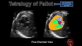 Fetal Echocardiography Tetralogy of Fallot [upl. by Augustus194]