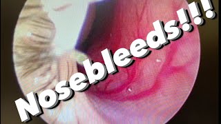 Nosebleeds epistaxis causes prevention treatments and more [upl. by Tris]