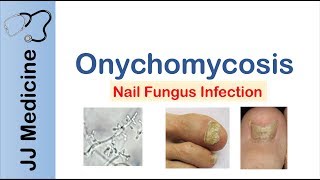 Onychomycosis  Nail Infection  Signs Symptoms Treatment [upl. by Etnoved]