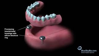 Overdenture Chairside Technique [upl. by Yona72]