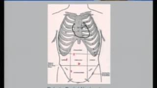 Recovery After Nephrectomy Ed Rampersaud MD [upl. by Yramanna]