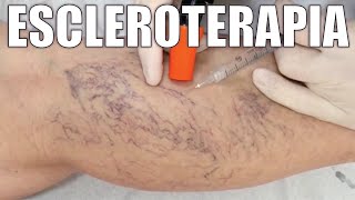 ESCLEROTERAPIA con ESPUMA para VÁRICES y ARAÑITAS VASCULARES 💉🦵🏻 Dr IVAN GUTIÉRREZ ⭐ FLEBOCENTER [upl. by Yellas856]