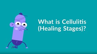 Cellulitis Healing Stages [upl. by Kingsly307]