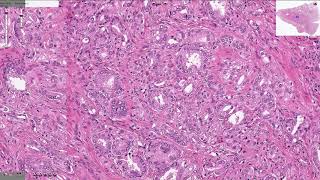 Prostatic Adenocarcinoma  Histopathology [upl. by Aihtnamas]