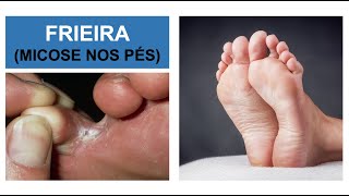 MICOSE NOS PÉS Frieira  Como combater Por Luiz Gameiro dermatologista [upl. by Otho958]