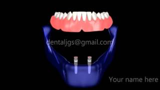 O ring attachment for overdenture Class Package [upl. by Yeung]