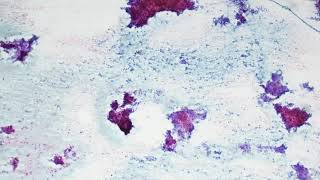 Pleomorphic adenoma Cytology [upl. by Rinna]