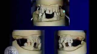 DENT 718 Tooth supported overdentures [upl. by Kirsten]