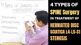 Lumbar Spine Surgery L4L5S1Herniated Disc Canal Stenosis Spinal Decompression MICRODISCECTOMY [upl. by Jansson]