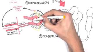 Chronic Kidney Disease CKD Pathophysiology [upl. by Ziagos]