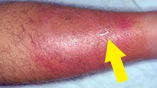 5 Effective and Easy Home Remedies for Cellulitis [upl. by Vandyke]