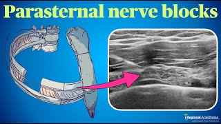 Parasternal Nerve Blocks [upl. by Frasco769]