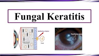 Fungal Keratitis [upl. by Kcirre]