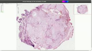 Pleomorphic Adenoma  Histopathology [upl. by Halyhs]