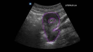 POCUS 1st Trimester Pregnancy Case 1 [upl. by Alleras]