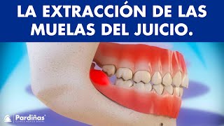 Extracción de muelas del juicio y pericoronatis  ¿Por qué se extraen las cordales © [upl. by Iona]