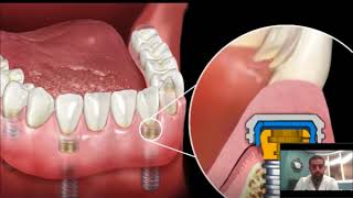 Dental Implant Overdenture  SnapIn Dentures [upl. by Nytsuj712]