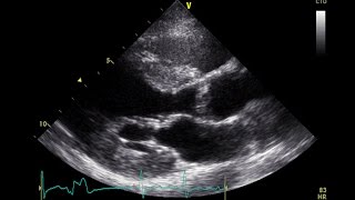 PVC Echo Parasternal Long Axis View  Aortic Stenosis [upl. by Davita]