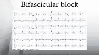 Bifascicular block [upl. by Lithea]