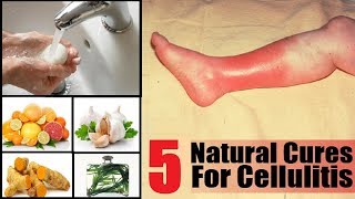 5 Home Remedies to Get Rid of Cellulitis Infection  By Top 5 [upl. by Ball]