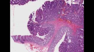 Histopathology Colon Tubular adenoma adenomatous polyp [upl. by Notsnhoj]