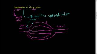 46Hyperemia vs Congestion [upl. by Blackington]