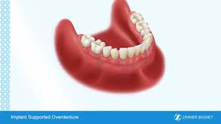 Implant Supported Overdenture [upl. by Imogen990]