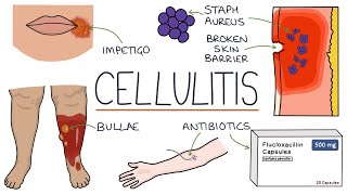 Understanding Cellulitis Skin and Soft Tissue Infections [upl. by Sergo]