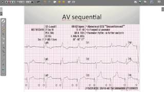 ECG Paced Rhythms [upl. by Eymaj]