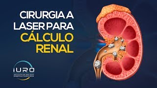 Cirurgia a Laser para CÁLCULO RENAL Pedra nos rins [upl. by Elka101]