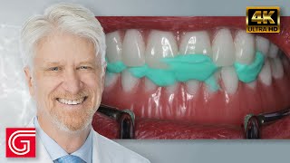 Restoration of Implant Overdentures by Timothy Kosinski DDS MAGD [upl. by Barlow]