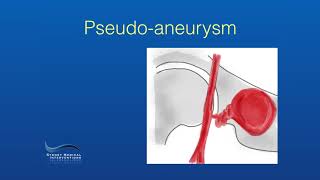 Endovascular Treatment of a Femoral Pseudoaneurysm [upl. by Anileve916]