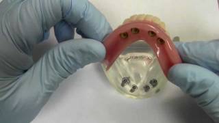 4Implant Ball Attachment Overdenture  Model Demonstration [upl. by Nelra]