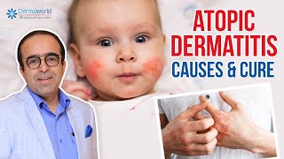 How is atopic dermatitis diagnosed [upl. by Nnyliak440]