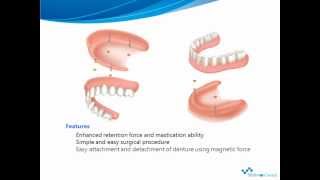 MagDenMagnetic Implant Overdenture System [upl. by Salohcim658]