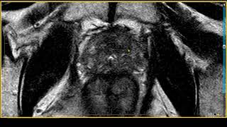 Prostate Cancer Surveillance on MRI [upl. by Bogey]