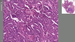 Endometrial Adenocarcinoma  Histopathology [upl. by Ykcaj]