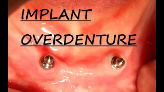 Implant Overdenture Planning  Part 1 Implant Supported Overdenture  Step by Step Planning [upl. by Langan]