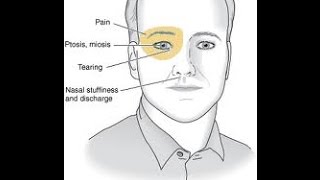 Cluster Headache [upl. by Asinet]